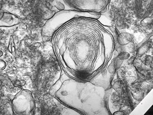 M,22y. | alveolar macrophage … phagocytosed surfactant M,22y. | alveolar macrophage … phagocytosed surfactant